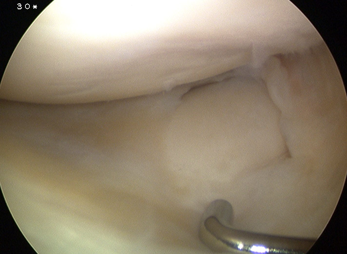 Incomplete Discoid Meniscus 